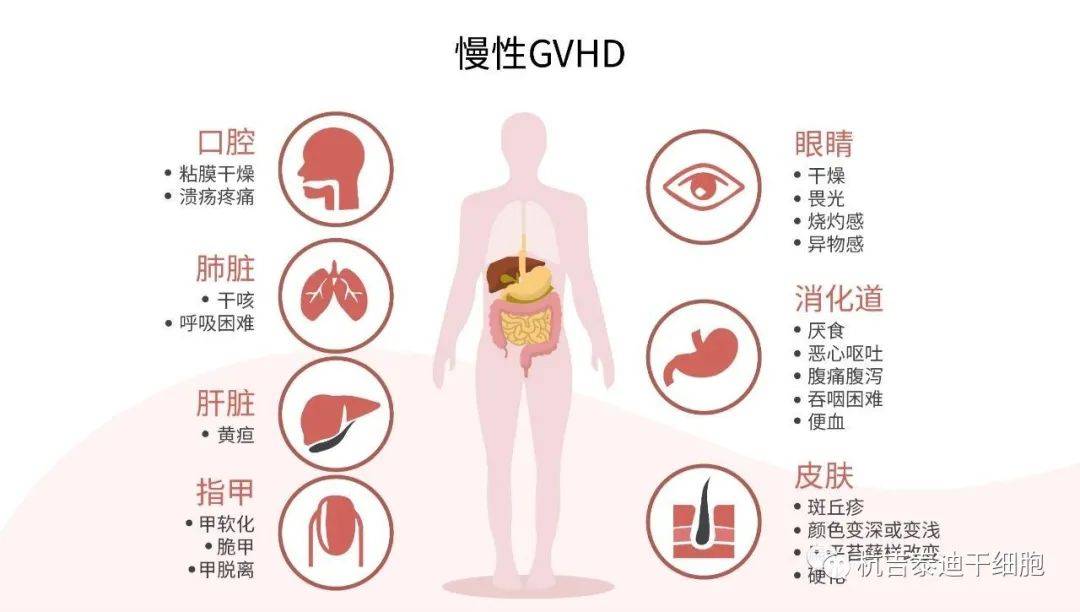 临床研究：干细胞治疗移植物抗宿主病安全有效，病情显著缓解 (图1)